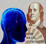 Deep Brain Stimulation